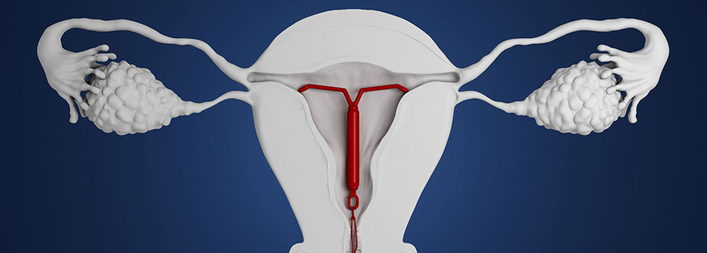 Dispositivo Intrauterino (DIU) Hormonal